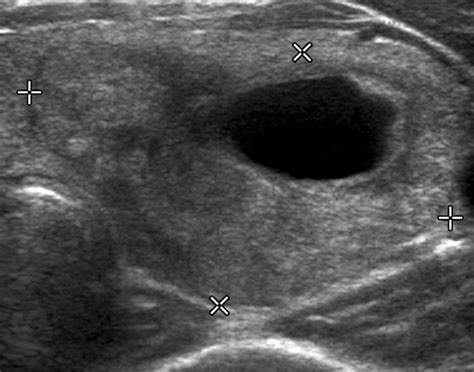 Thyroid Nodules Biopsy