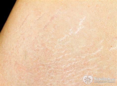 Растяжки у подростков - причины, способы лечения, народные рецепты