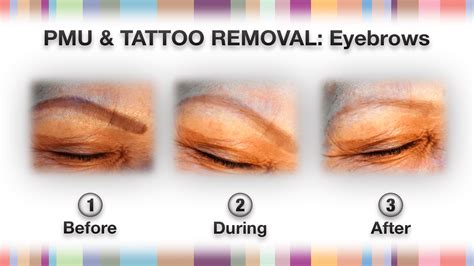 Permanent Makeup Tattoo Removal NPM Shop