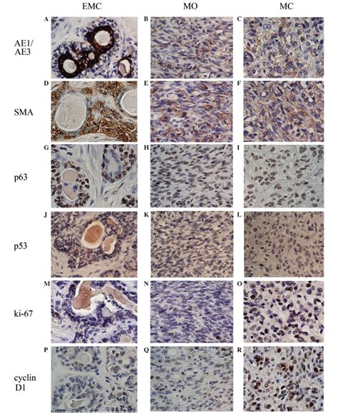 Primary Epithelial Myoepithelial Carcinoma Of The Lung A Case Report