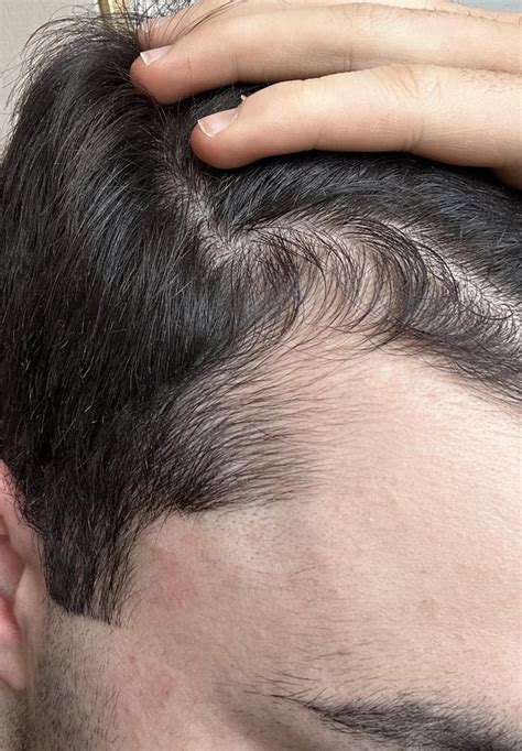 Minoxidil 3 Month Results Hairline Growing In R Tressless