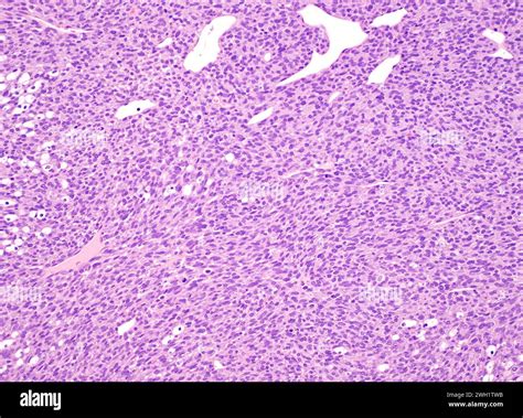 Congenital Mesoblastic Nephroma Light Micrograph Stock Photo Alamy