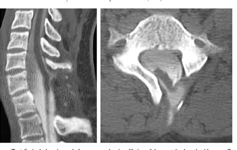 Figure From Postoperative Spinal Cord Herniation With