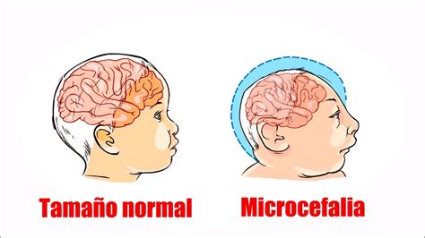 Virus Del Zika Y Sus Efectos Durante El Embarazo Youtube