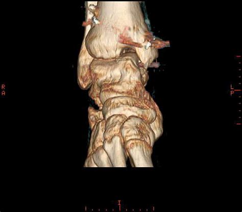 Fresh Frozen Osteochondral Allograft Reconstruction Of A Giant Cell