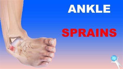 Ankle Sprains Lateral And Deltoid Ligaments High Ankle Sprains Youtube