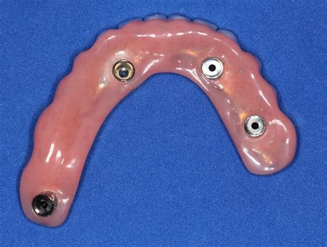 Correct Design Of Fixed Implant Bridges All On 4 To Allow Proper Cleaning Dental Implant Center