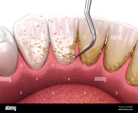 Oral Hygiene Scaling And Root Planing Conventional Periodontal Therapy Medically Accurate 3d