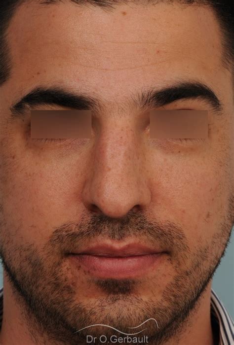 Photos De Rhinoplastie Chez L Homme Avant Et Apr S