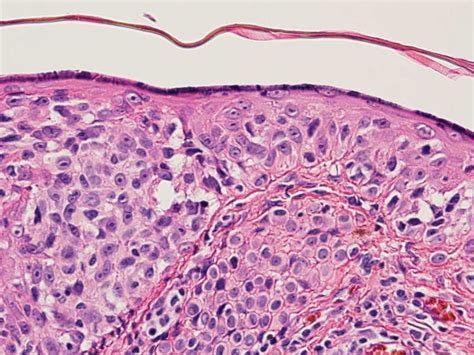 Amelanotic Melanoma Histology