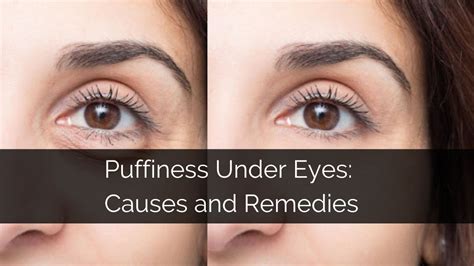 Eye Puffiness Treatment Ayurvedic At James Perea Blog