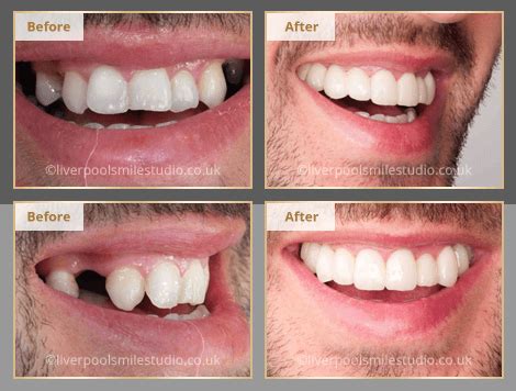 Dental Crowded Teeth Liverpool Liverpool Smile Studio