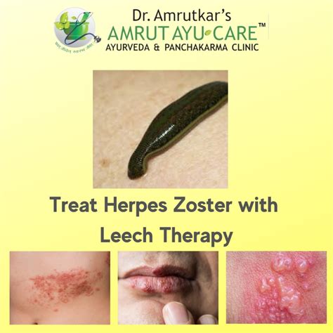 Herpes Zoster Ayurvedic Management Leech Therapy