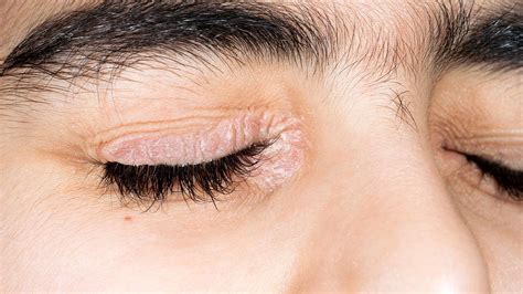 Psoriasis Eyelid