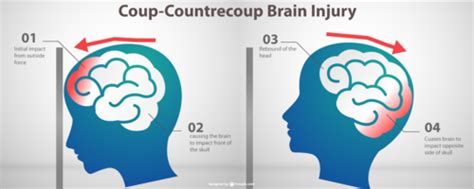 Traumatic Brain Injury Flashcards Quizlet