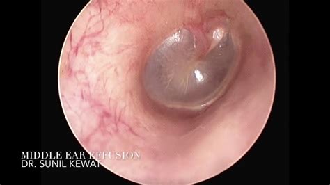 Middle Ear Effusion Tympanic Membrane Movements On Valsalva Maeuvre