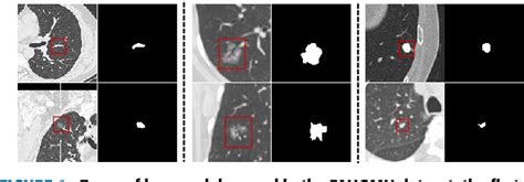 Figure 1 From DMC UNet Based Segmentation Of Lung Nodules Semantic