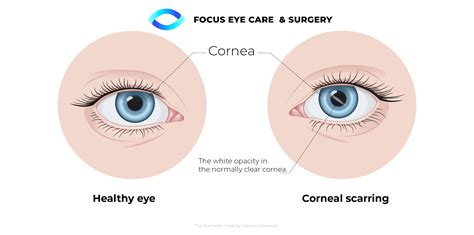 Corneal Scar