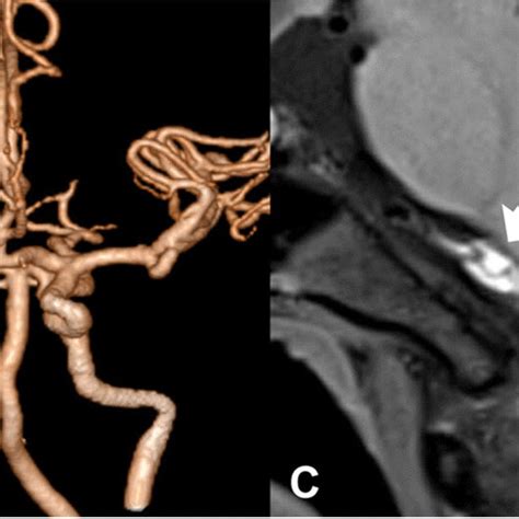 A Year Old Female Presented With Headache Dizziness And Vomiting