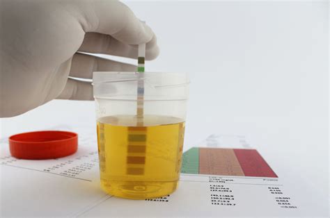 Urine Protein Purpose Procedure Results Risks And Lti