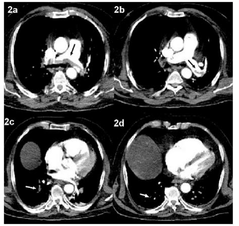 CT Pulmonary Angiography With Apneic Oxygenation On A Single Row