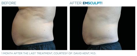 Emsculpt Neo Burn Fat And Build Muscle Charlotte Nc