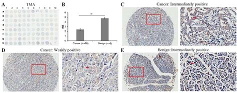 Immunohistochemical Staining For Sox7 In Pancreatic Cancer And Adjacent