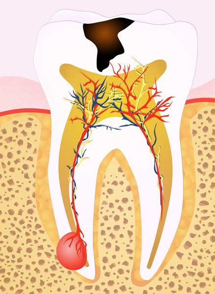 Pulpitis Dental Qué es Síntomas Tratamiento Clínica Dental en