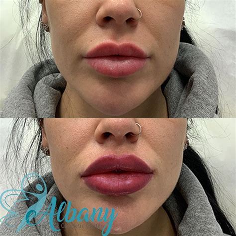 Edmonton Lip Shaping Experts Case No Albany Laser