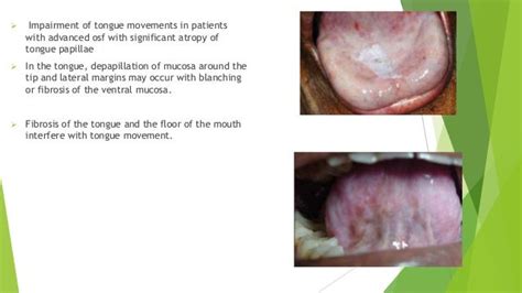 oral submucous fibrosis