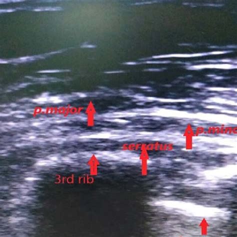 Us View Of Pectoral Region Download Scientific Diagram