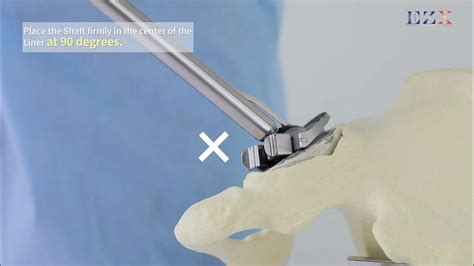 [imedicom S Product] Ezx Acetabular Cup Removal System How To Use Youtube