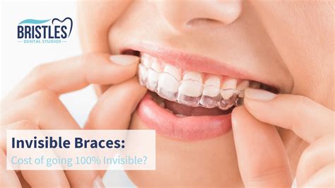 Invisible Braces Cost In Chandigarh What Are The Options Available