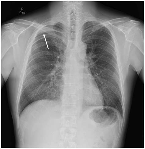 Osteoid Osteoma Of The Rib With Strong F 18 Fluoro Deoxyglucose Uptake Mimicking Osteoblastoma