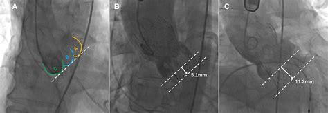 Frontiers Effect Of Eccentric Calcification Of An Aortic Valve On The