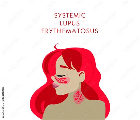 Sle Red Systemic Lupus Erythematosus Red Butterfly On The Face Skin