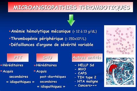 Ppt Microangiopathies Thrombotiques Et Cancer Powerpoint Presentation