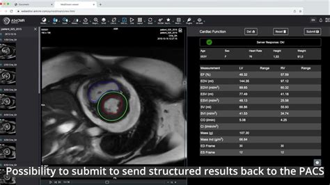 Meddream Dicom Viewer Integrated With Ai4cmr Webeditor For Cardiac Imaging Using Ai Youtube