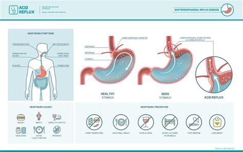 Heartburn Symptoms & Treatment | Phoenix | Chandler AZ