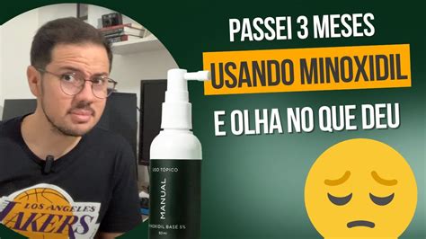 Meses Usando Minoxidil E Finasterida Da Manual E Esse O Resultado