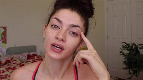 How To Have Confidence With Acne Of Course Youtube