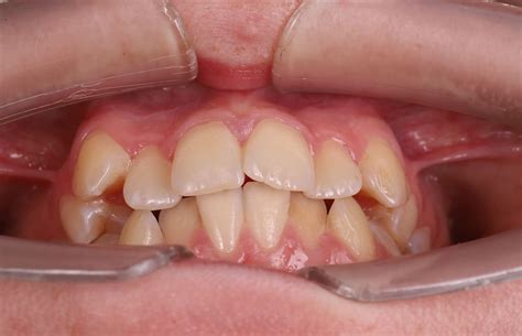 Treatment Of Tooth Crowding And Spacing With Invisalign Aligners