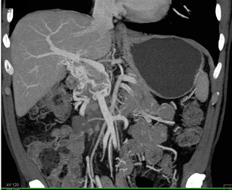 Portal Vein Thrombosis With Cavernous Transformation Of The Portal Vein