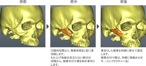 頬骨形成・頬骨縮小で頬の出っ張り解消｜骨切り専門クリニカ市ヶ谷