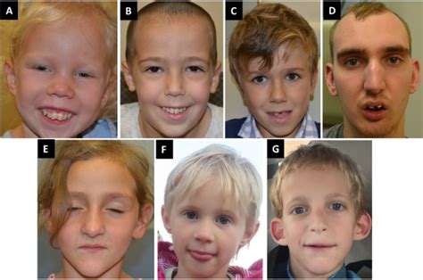 Figure Facial Features Of Individuals With Genereviews