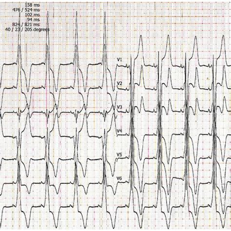 Cardiac Amyloidosis Ecg Showing Significant 1st Degree Av Block And