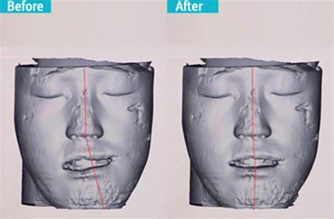 Operasi Dua Rahang Di Korea Rahang 【id Hospital】