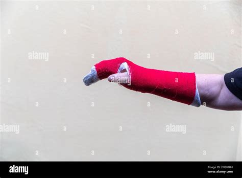 Broken Arm Bone In Cast Red Stock Photo Alamy