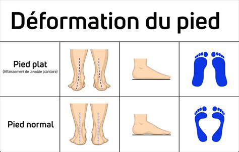 Pathologies Pieds Plats Atelier Yuwa Ciao Jp