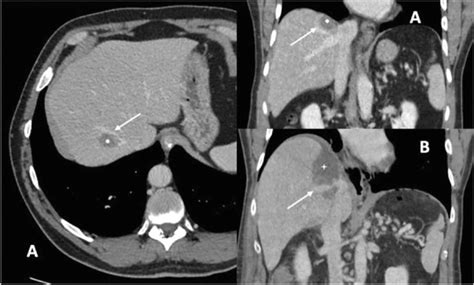 Robotic Liver Resection In The Posterosuperior Segments As A Way To